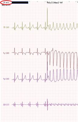 Case Report: Wide-to-Narrow QRS Tachycardia in a 3-Month-Old Infant